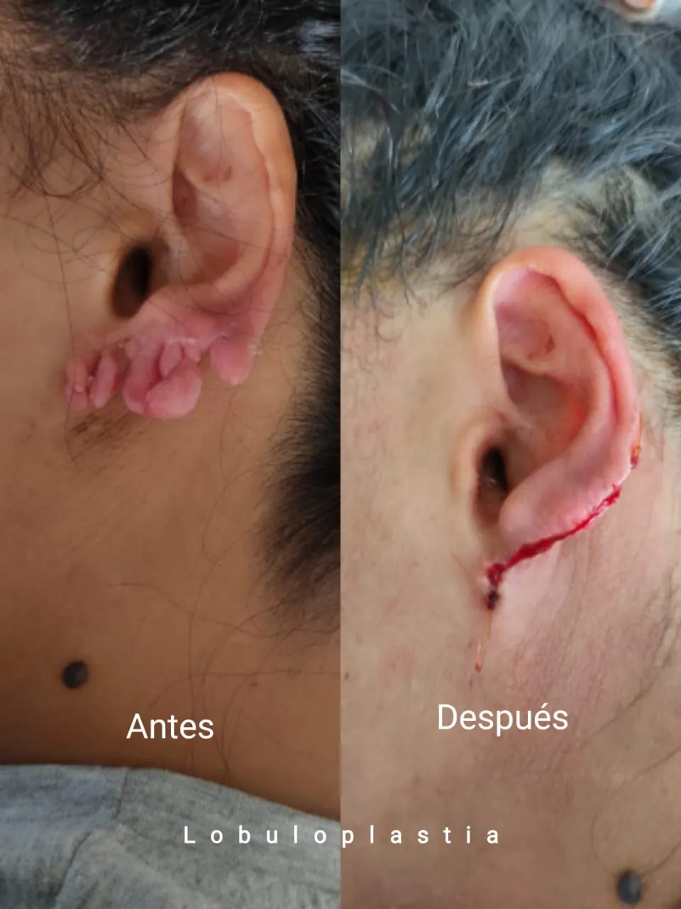 Reparación estética de lóbulo auricular