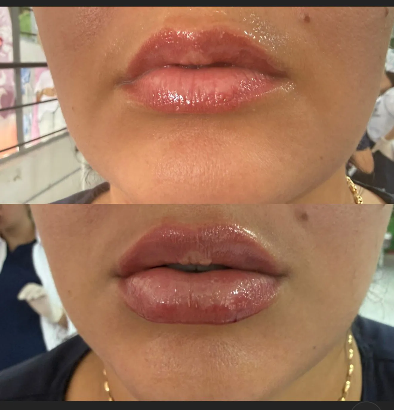 Perfilado labial detallado - Dra. Erika Caballero