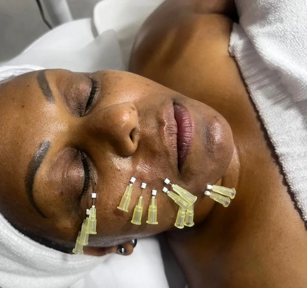 Aumento de volumen en labios con ácido hialurónico - Dra. Erika Caballero