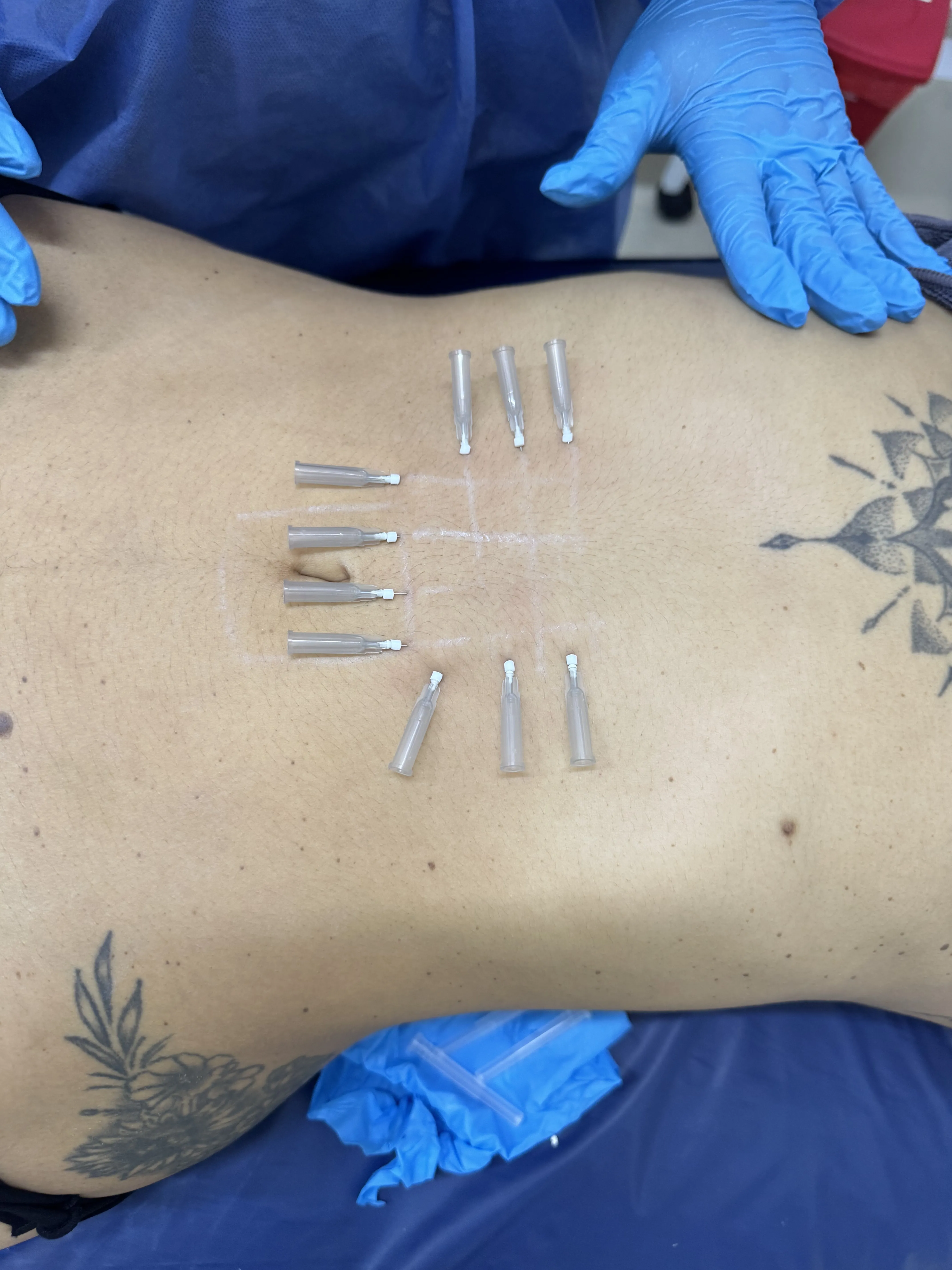 Curso Toxina Botulínica