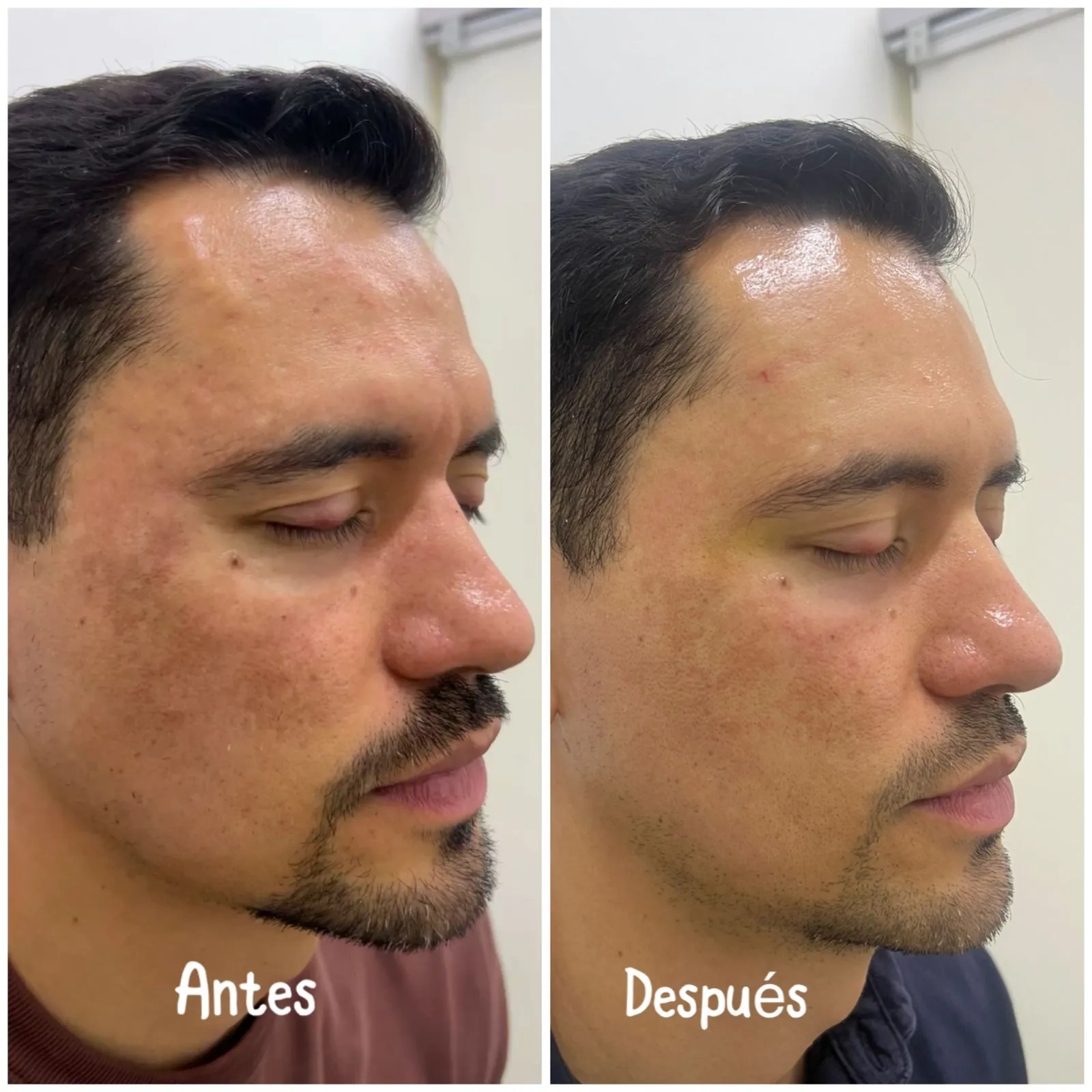 Tratamiento de manchas y rejuvenecimiento facial - Dra. Erika Caballero